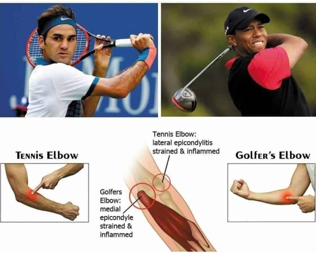 osteopati forskel på tennis og golf albue - Modtag behandling hos JT Osteopati i Køge