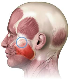 Anatomisk billede der viser kæbemuskler og de typiske steder hvor smerte kan fremkomme